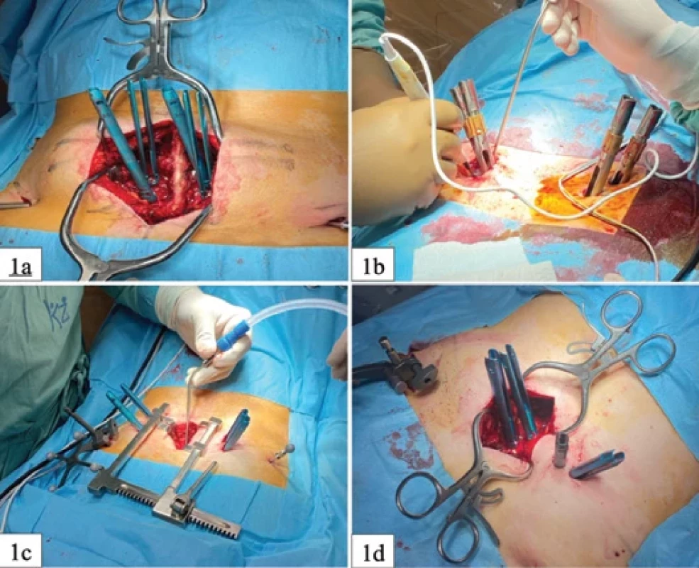Various robotically assisted surgical techniques.