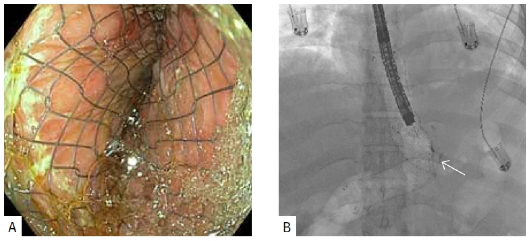 A) Metalický stent komprimovaný v těsné „twist“ stenóze po sleeve resekci žaludku. B) RTG obraz – šipka ukazuje místo angulace a rotace stentu ve stenóze.