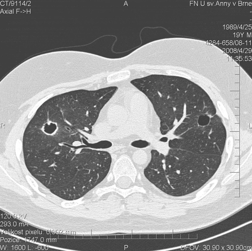 Multidetektorové CT 64 řady GE Lightspeed VCT:HRCT plic: Stacionární obraz denzit mléčného skla. Největší z kulovitých ložisek v levém laloku výrazně zmenšeno na průměr 16 mm. Jeho stěny jsou hladké a tenké. Další ložiska vymizela nebo mají zcela jemnou stěnu.V horním laloku pravé plíce přetrvává kulovité ložisko se silnější stěnou o velikosti 20 mm.