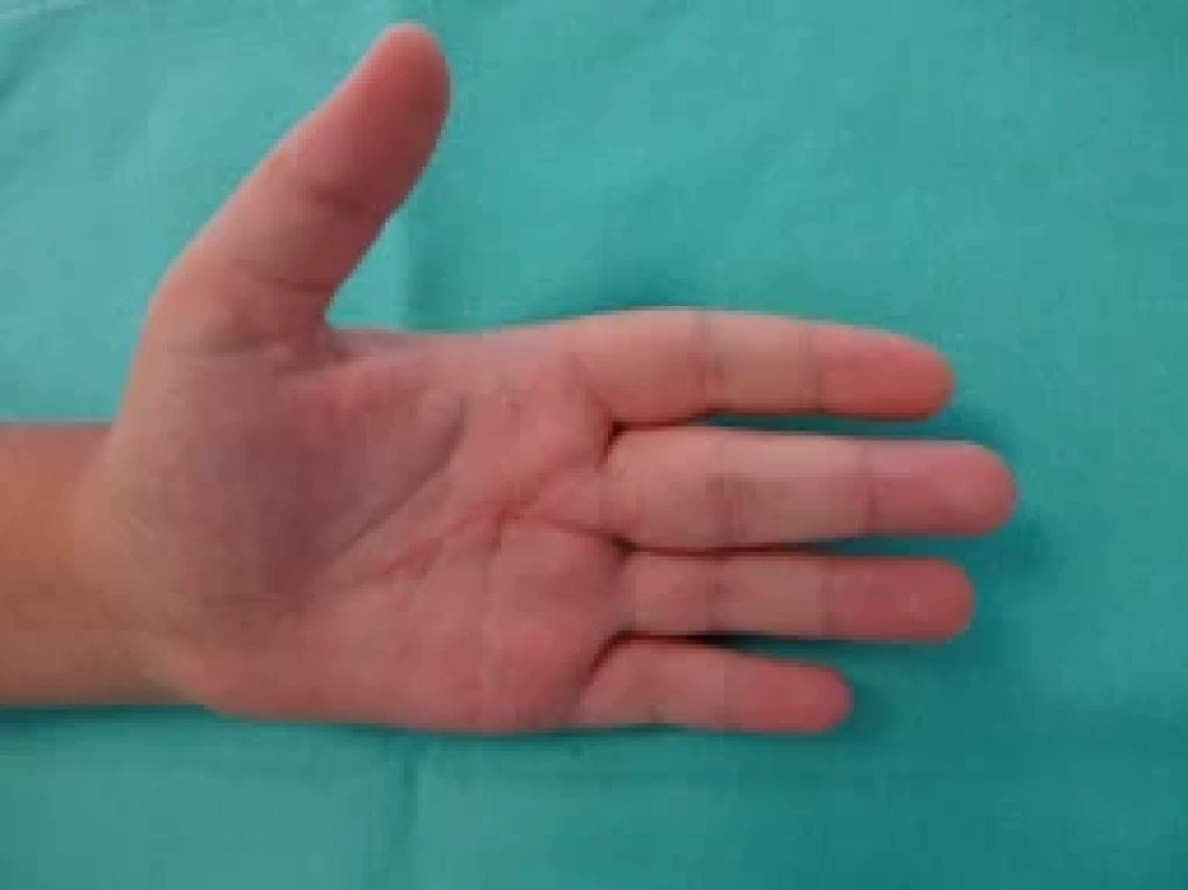 A full range painless motion postoperatively – extension.