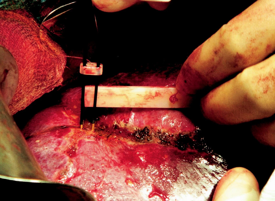 Zavádění radiofrekvenční sondy podél předpokládané resekční linie a vytváření tepelné koagulační nekrózy
Fig. 4. Introduction of the radiofrequency probe along the expected resection line and coagulation necrosis formation 