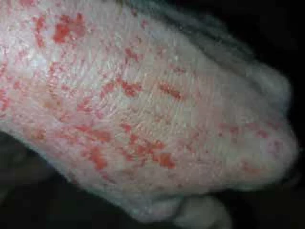 Exkoriace