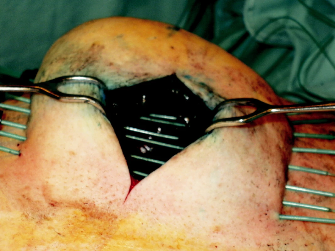 Provedení peroperační intersticiální brachyterapie lůžka tumoru pomocí plastikových vodičů
Fig. 2. Peroperative interstitial brachytherapy of a tumor focus using plastic leaders