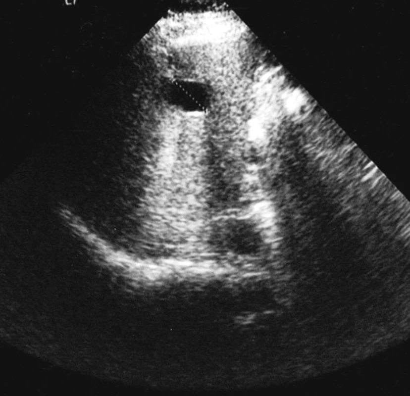Kontrolní ultrasonografické vyšetření po provedení laparoskopické fenestrace solitární cysty (obrázek 4). Drobné reziduum cysty velikosti 2,8 cm
Fig. 5. Control ultrasound examination following laparoscopic fenestration of the solitary cyst (figure 4). A minor residue of the cyst measuring 2.8 cm