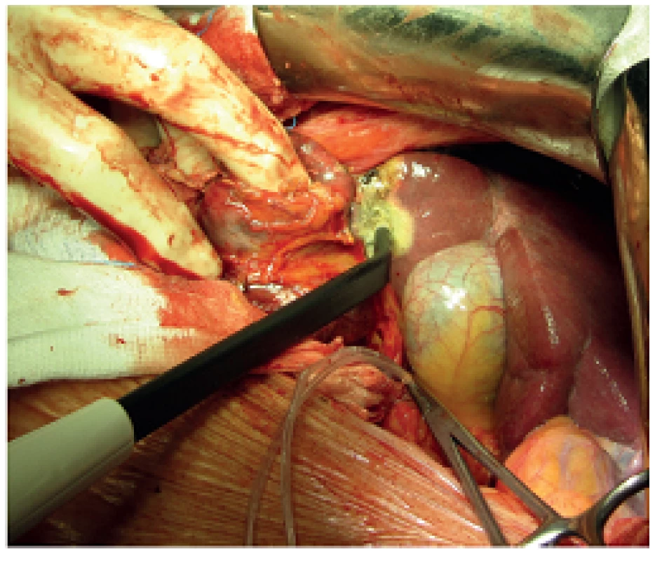 Průběh resekce
Fig. 4: Process of resection