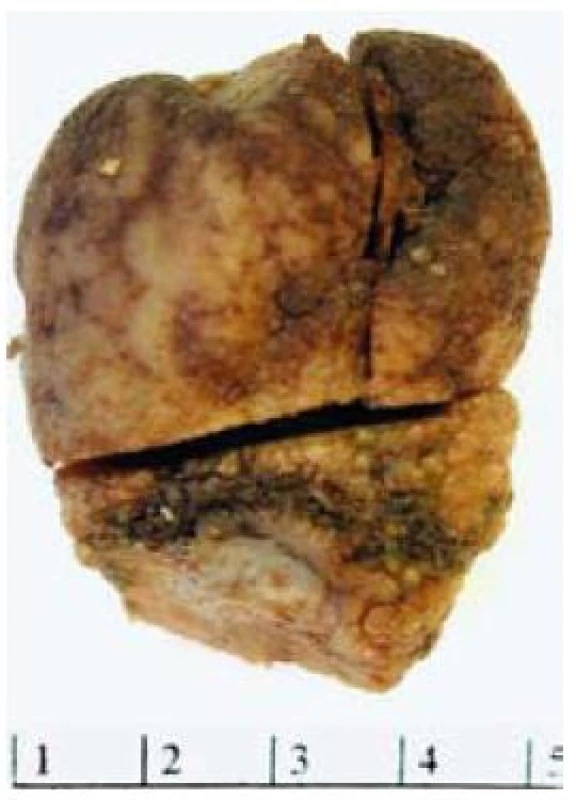 Makroskopický vzhled submukózně uloženého fibroidního zánětlivého polypu v resekátu.