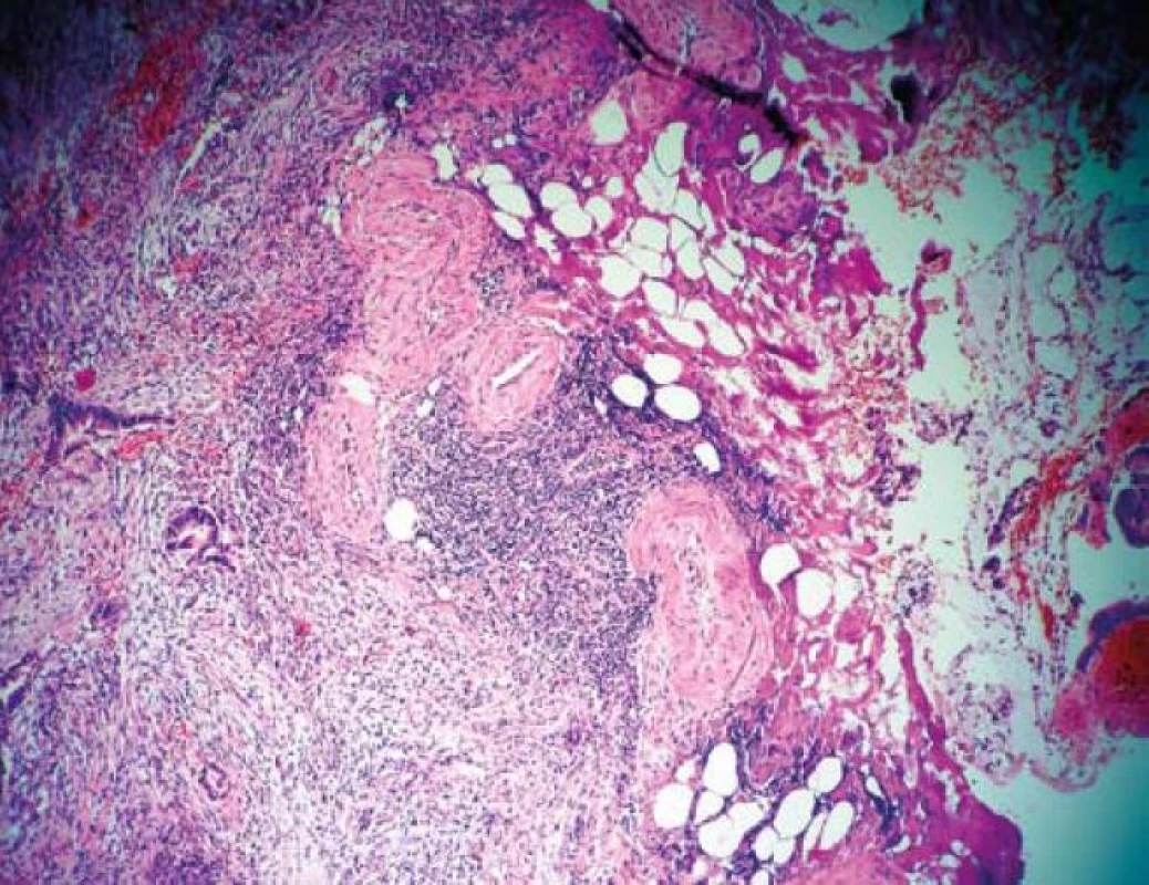 Submukózně invadující karcinom dosahující téměř až k resekční linii u pacienta s ulcerózní kolitidou.
Fig. 8. Submucosal carcinoma extending close to the resection line in patient with ulcerative colitis.