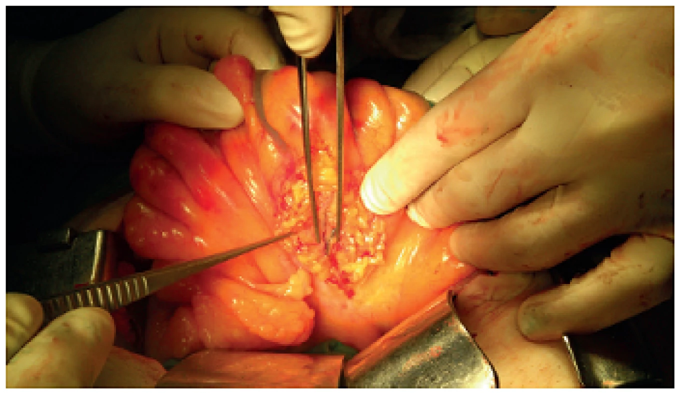 Znázornění lymfatik barvivem po otevření serózy
Fig. 3: Lymphatic vessels after visceral peritoneum opening