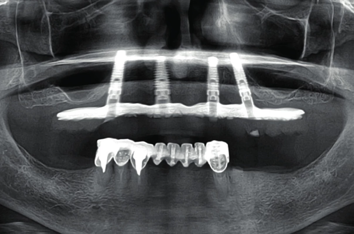 All-on-4. Oba krajní implantáty jsou tilted