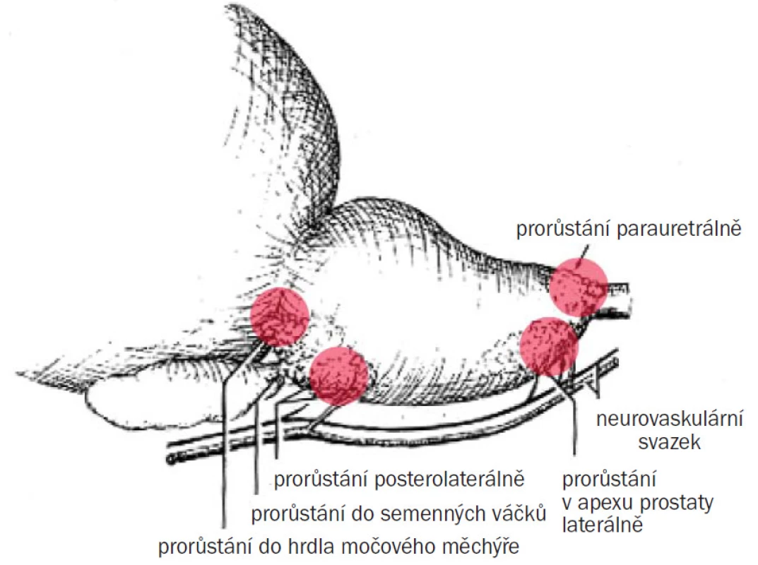 Prorůstání karcinomu prostaty.