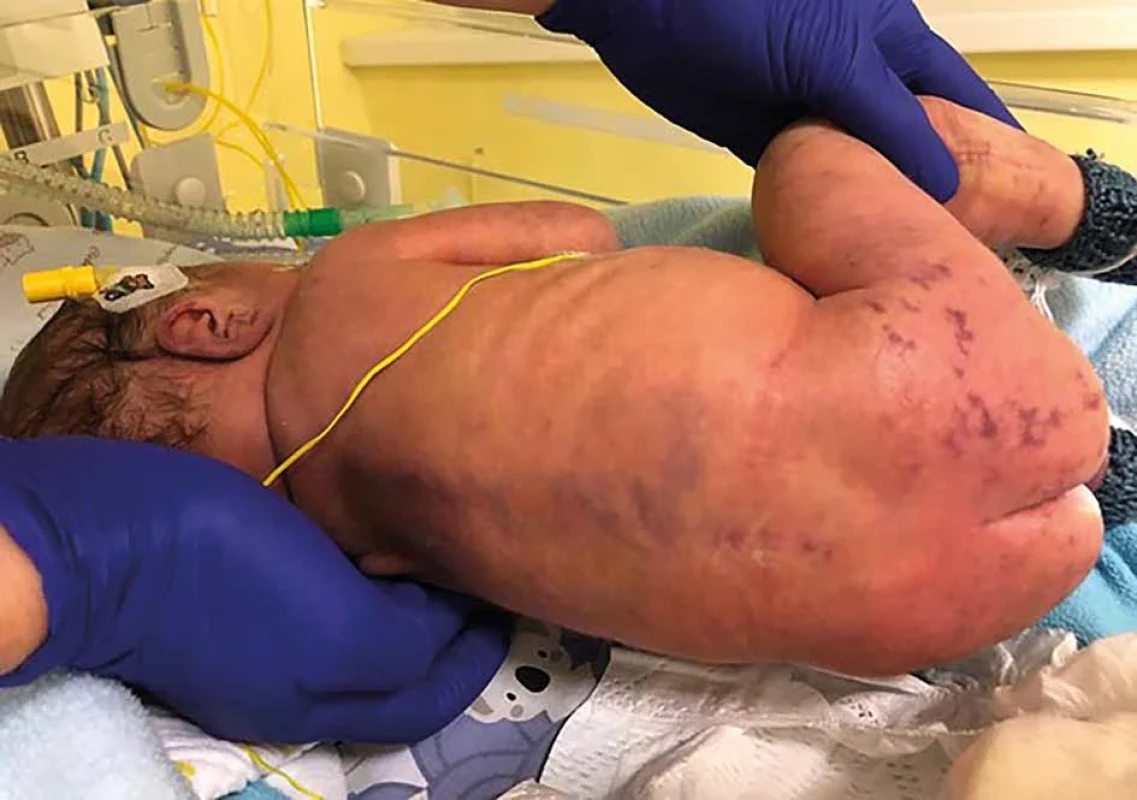 Hemoragické lézie prvé dni života na chrbáte a zadočku pri purpure fulminans