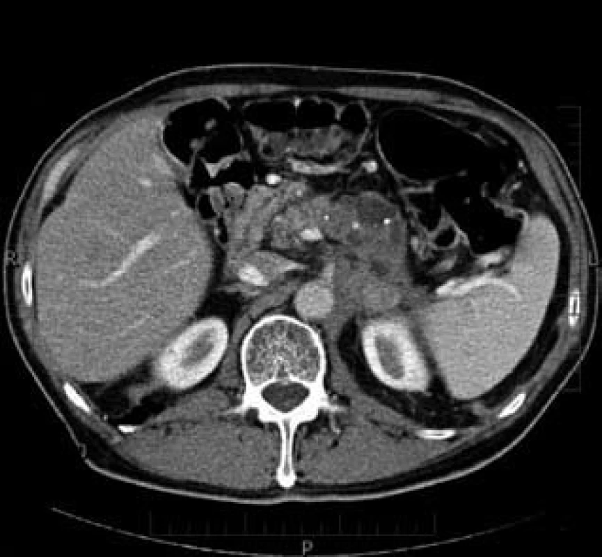 Karcinom těla a kaudy pankreatu – CT nález.
Fig. 2. Pancreatic body and tail carcinoma – CT finding.