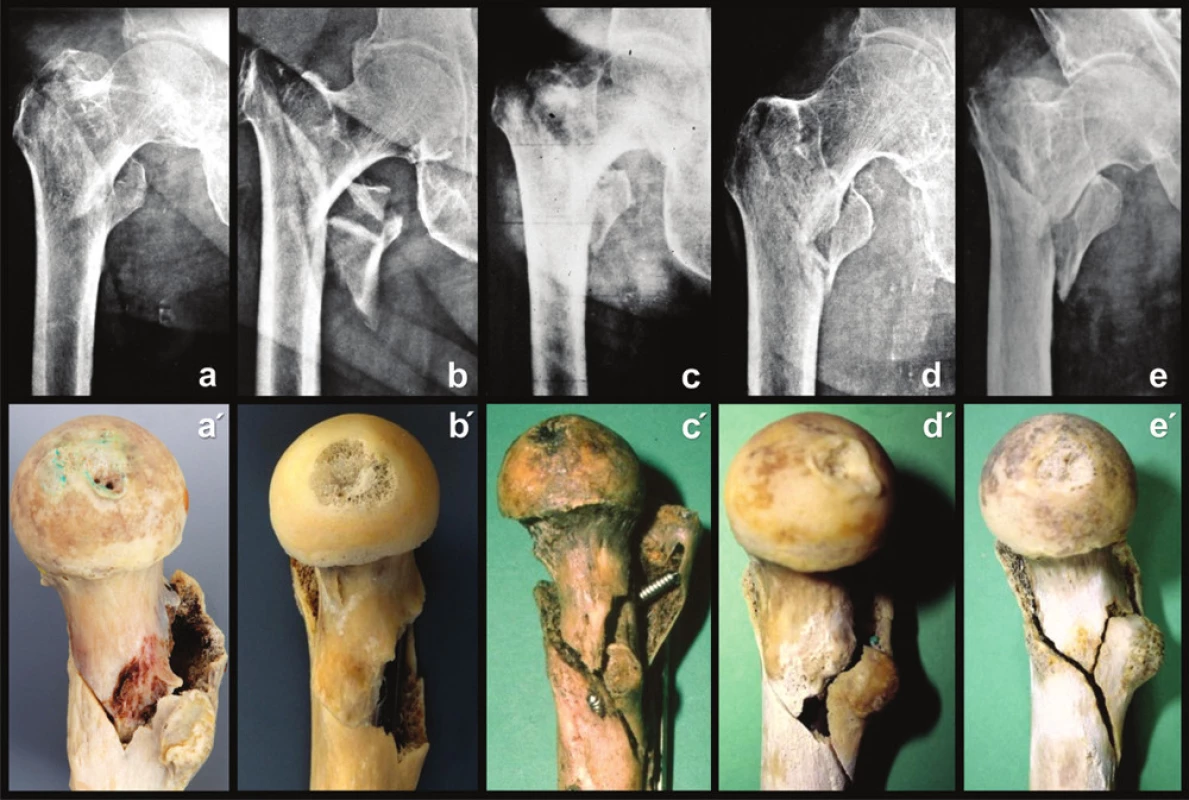 Stav Adamsova oblouku 
Korelace rtg a anatomického preparátu, pohled z mediální strany: a – e – rtg snímek; a´ – e´– anatomický preparát zlomeniny z rtg snímku, pohled z mediální strany.
Fig. 11: Condition of the Adams ´arch 
Correlation of the radiograph and anatomical specimen, medial view: a – e – radiographs; a´ – e´– anatomical specimen of the fracture from the radiograph, medial view.