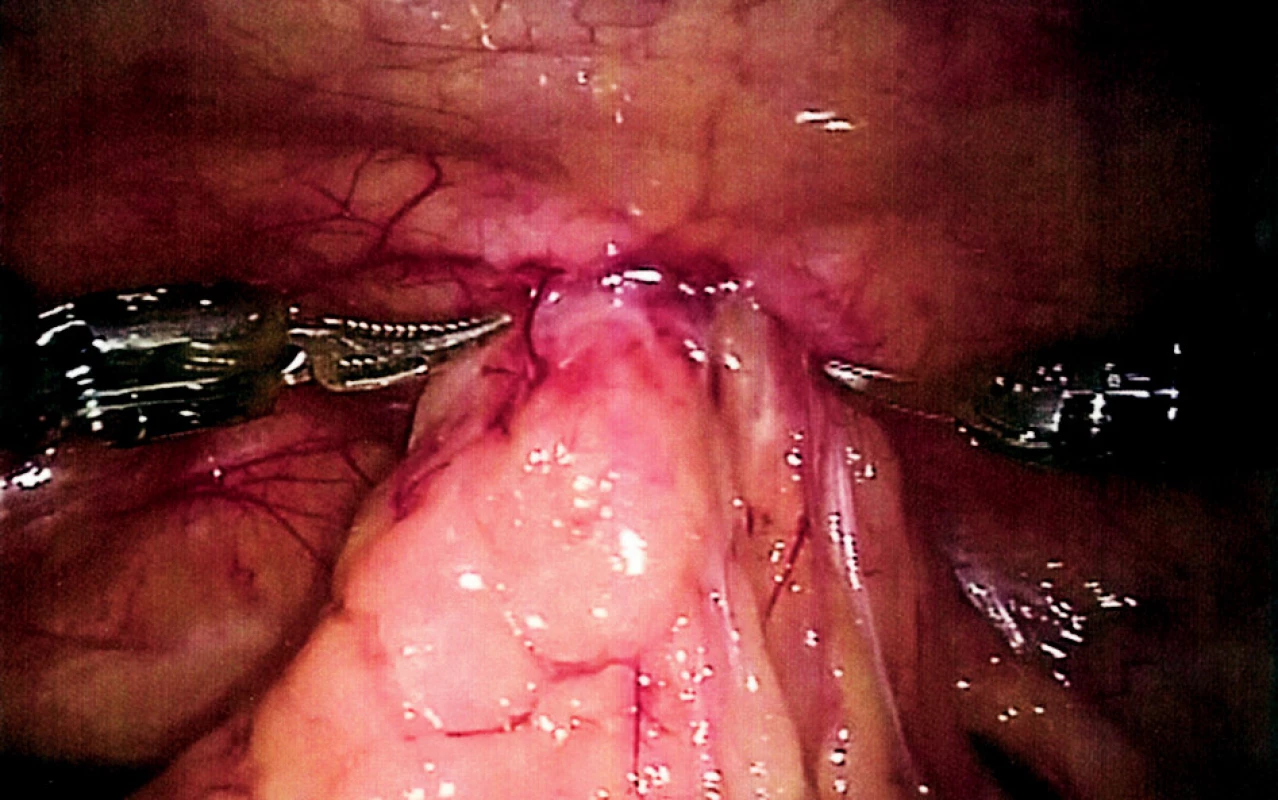 Fixace omenta v kýlní brance
Fig. 3. Fixation of the omentum in the hernia orifice