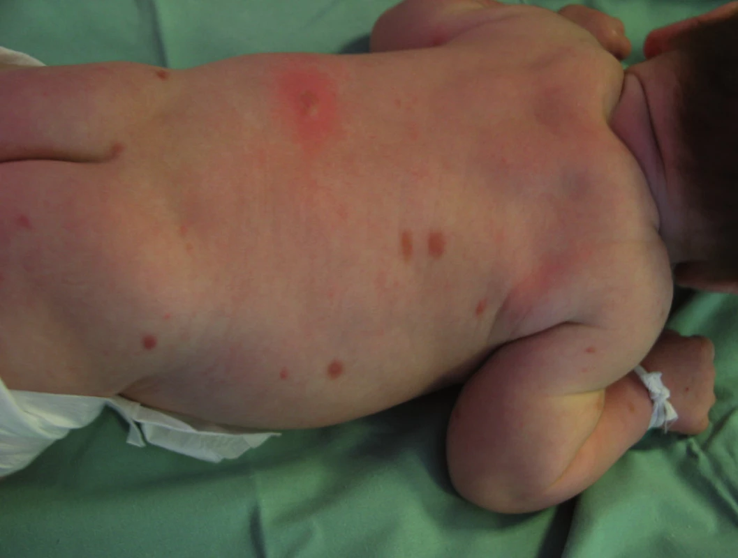 Urticaria pigmentosa – nahnědlé papulky průměru 3-4 mm, pozitivní Dariérův znak.