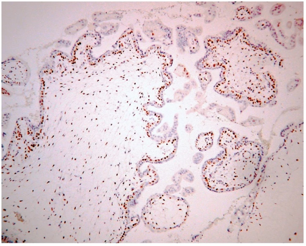Expresia p57 v parciálnej hydatidóznej mole. Imunohistochemická reakcia s monoklonálnou protilátkou p57 (57P06). Silná jadrová pozitivita vilózneho cytotrofoblastu, extravilózneho trofoblastu a stromálnych buniek klkov. Vizualizácia DAB (zväčšenie 200x).