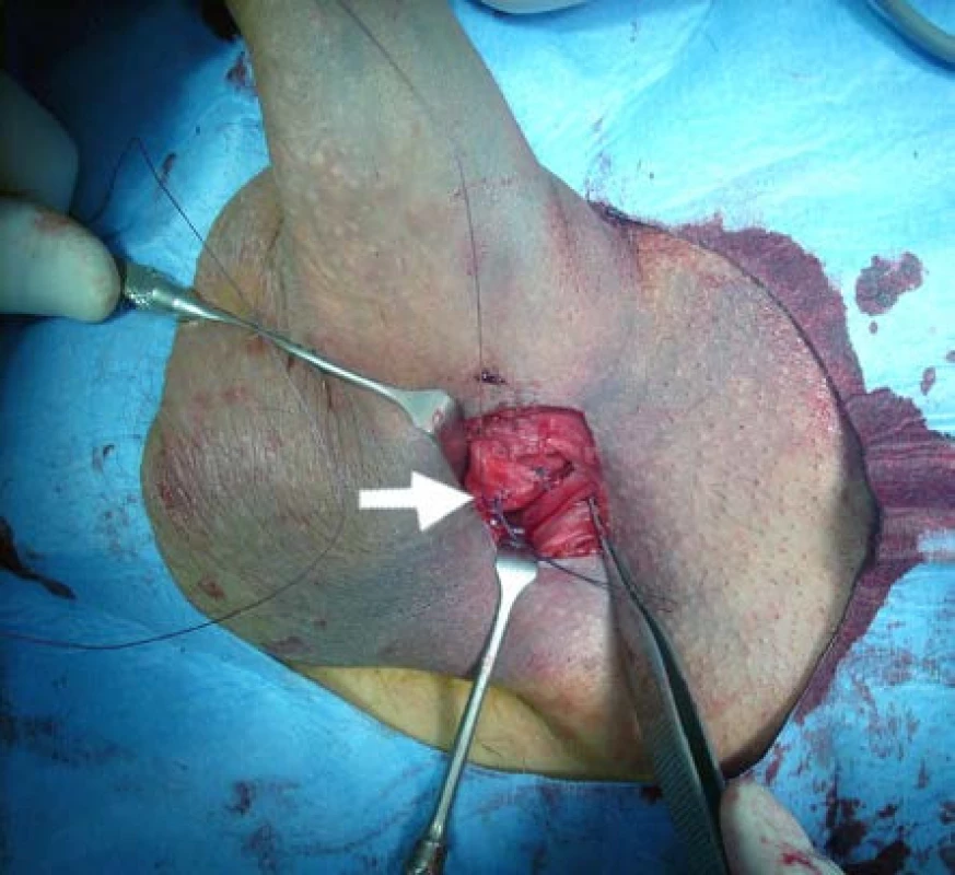 Sutura ruptury jednotlivými vstřebatelnými stehy Vicryl 3/0
Fig. 4. Suture of the rupture with single Vicryl 3/0 absorbable sutures