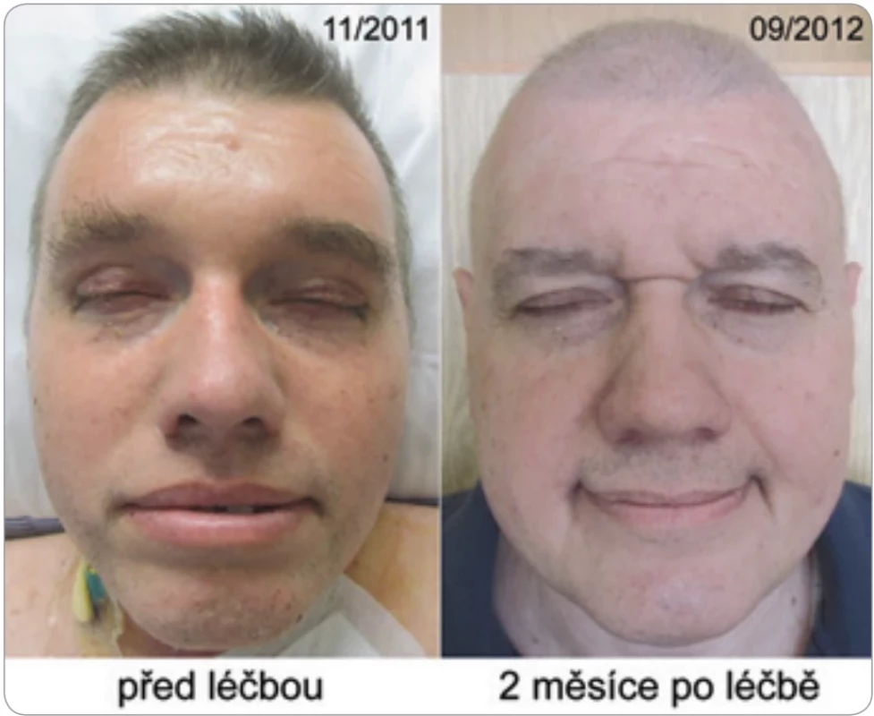 Skleredém indukovaný monoklonálním imunoglobulinem. Po dosažení kompletní remise vymizel a znovu se vyskytl v době recidivy myelomu. Kůže pacienta byla tak tuhá, že nebylo možné vytvořit kožní řasu. Převzato z [24]. Publikace fotografi e se souhlasem pacienta.