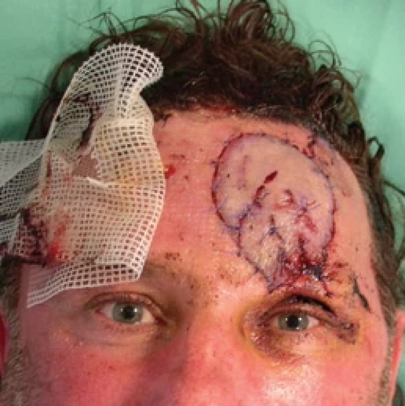 Flap ischemia reoccurs the day after revision. Source: archive of authors.