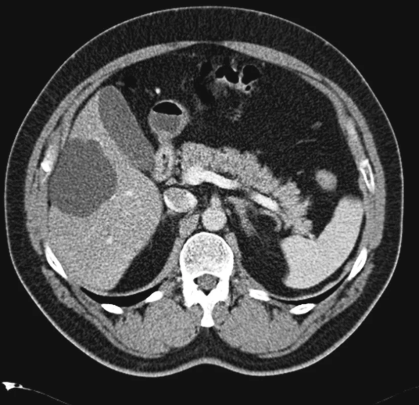 Solitární cysta velikosti 7 cm. Vyšetření výpočetní tomografií s kontrastní látkou
Fig. 4. A solitary cyst measuring 7 cm. Contrast CT examination
