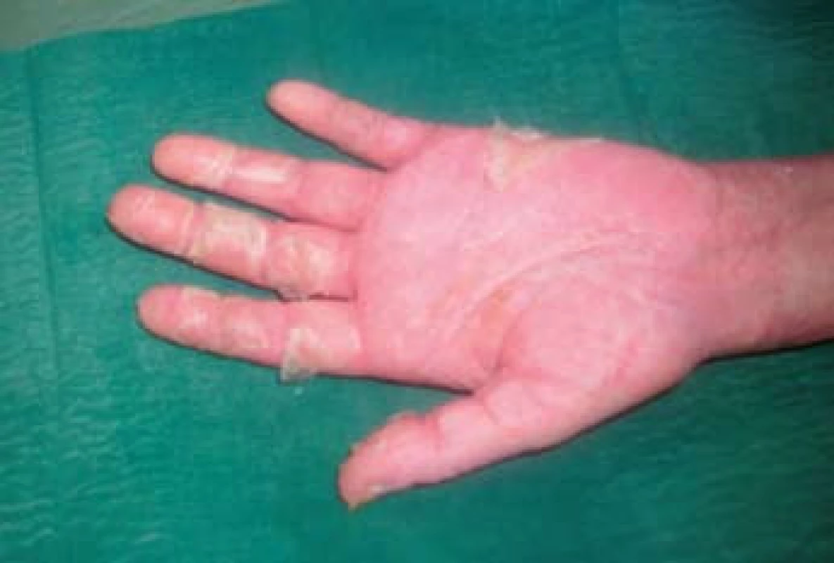 Olupující se exantém na dlaních.
Fig. 4. Peeling exanthem on the palms.
