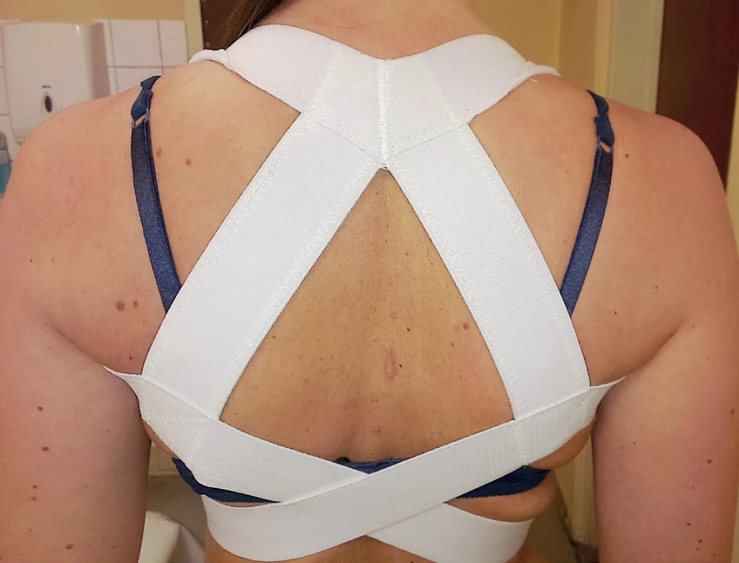 Vyrovnávajúci ramenný pás pri lézii n. thoracicus longus so scapulou alatou vpravo.