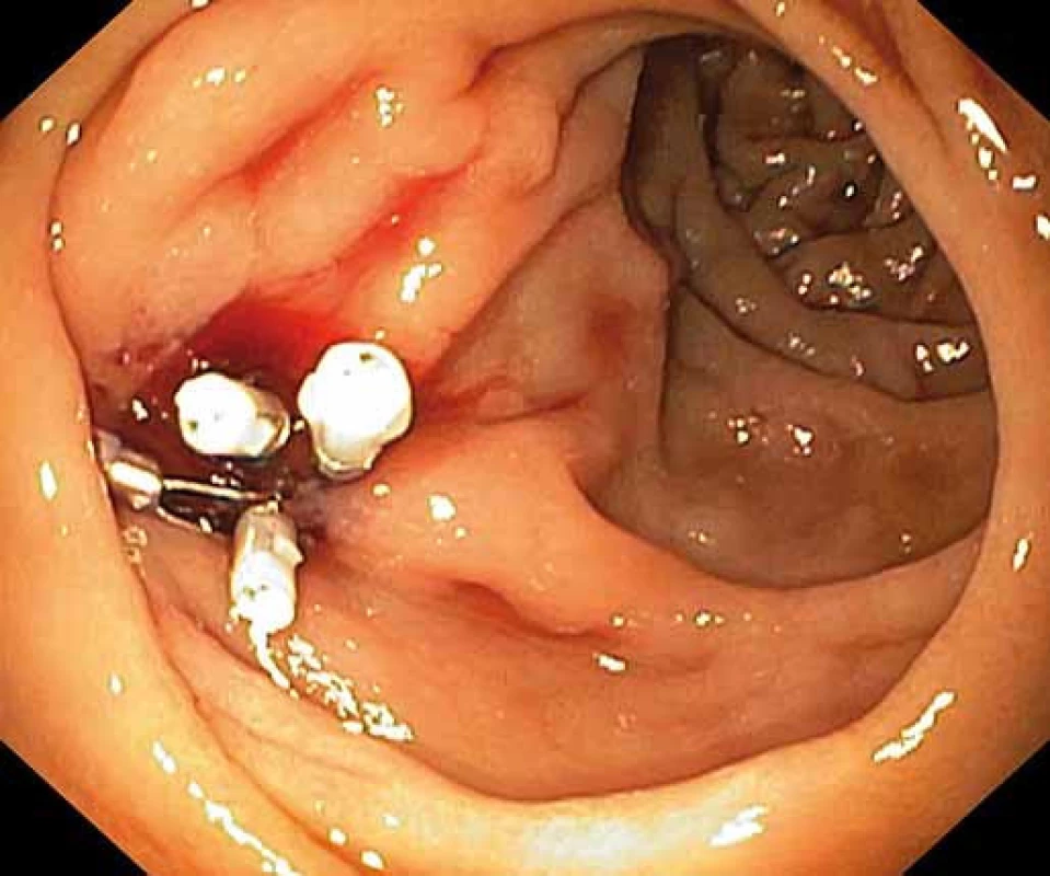 Hemoklipy umístěné do oblasti ústí píštěle.
Fig. 2. Hemoclips located in the fistula orifice.