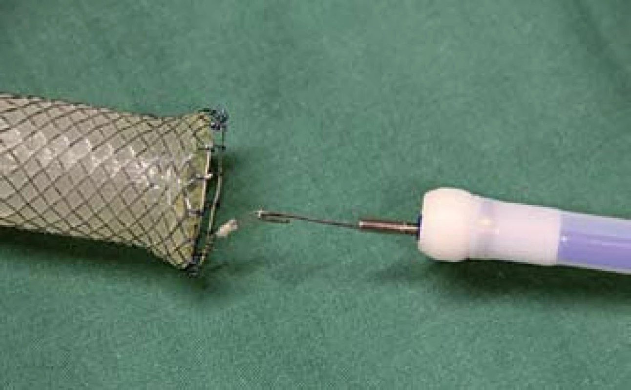 Stent s očkem vývazového lanka pro extrakci zachyceným do extraktoru.
Fig. 12. Stent with a loop of an unbinding cable for extraction, attached to the extractor.
