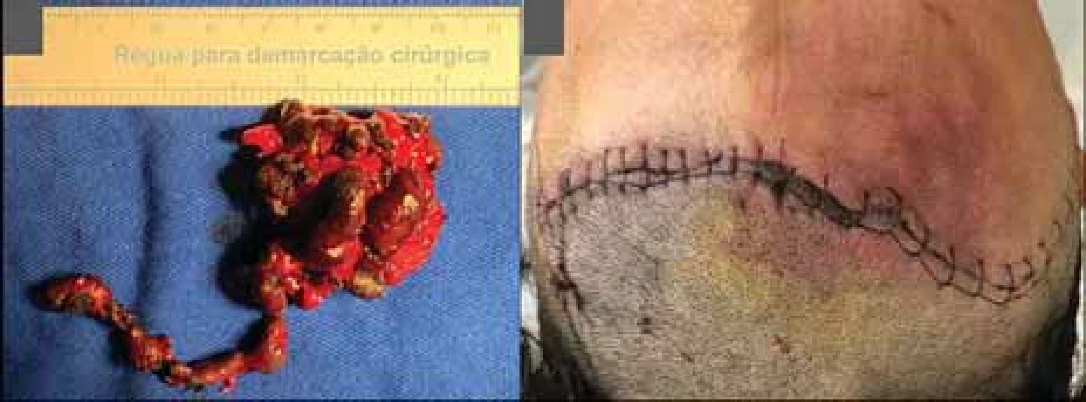 A) Figure showing the macroscopic appearance of the lesion after resection. B) Figure showing appearance after primary closure.