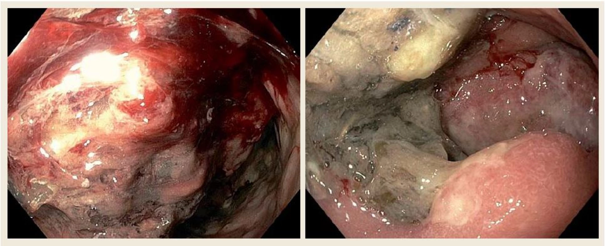 Horní endoskopie našeho pacienta ukazující objemné květákovité masy při postižení D2 difuzním  velkobunečným B lymfomem.
Fig. 3. Upper gastrointestinal endoscopy of our patient showing large fungating masses of diffuse B-cell lymphomas  in the second part of the duodenum.