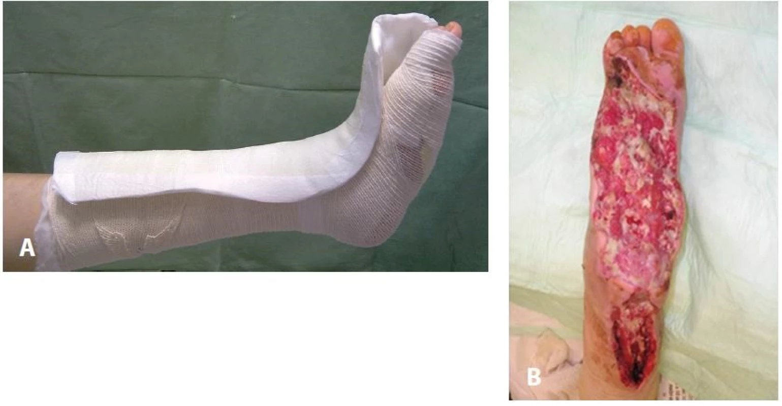 Pretibiální L-dlaha (A), často aplikovaná u rozsáhlých ztrátových postiženích dolní končetiny (B)
Fig. 6: Pretibial removable contact L-splint (A) often applicated after extensive debridements and necrectomies of the diabetic foot (B)