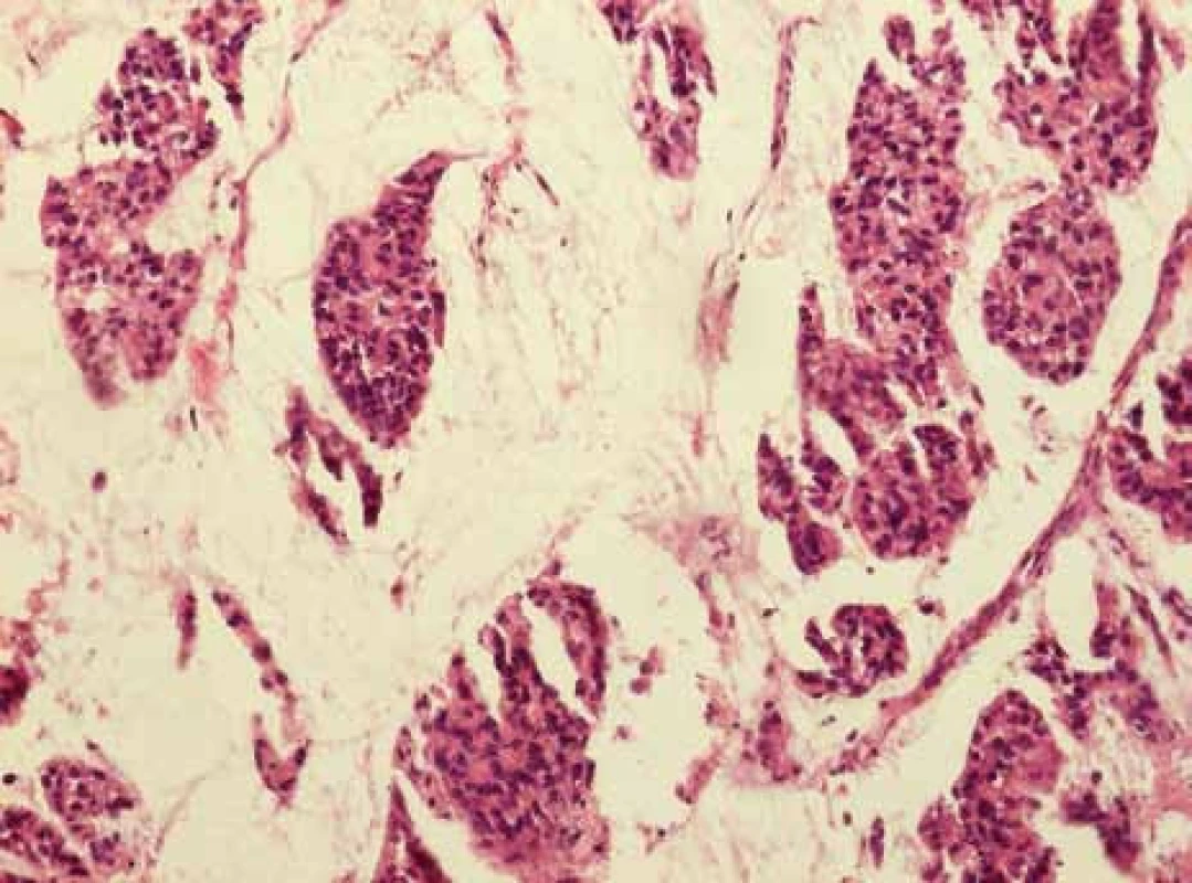 Identický případ, histologicky se jedná o mucinózní karcinom a invazivní duktální karcinom NOS varianta, grade 3, estrogenní receptory 50 %, progesteronový receptor negativní.