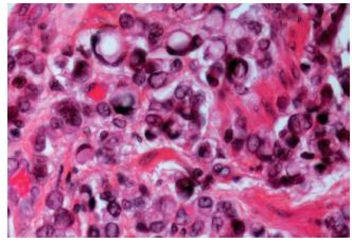 Signet ring-cell component in an UC.