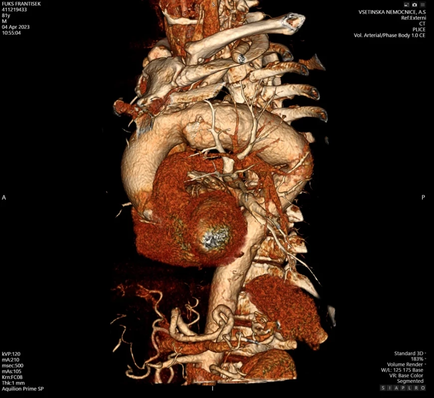 Aneurysma oblouku aorty – 3D CT rekonstrukce