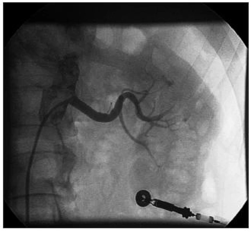 Angiografie levé renální tepny po implantaci stentu