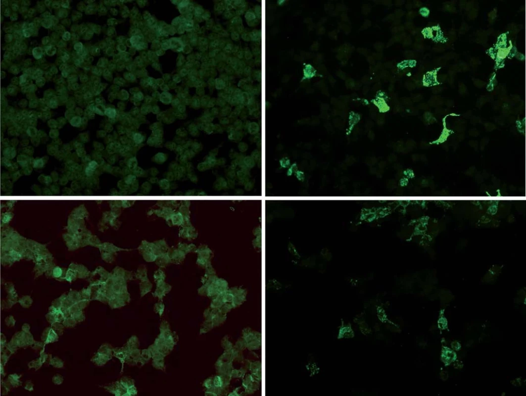 Ukázka pozitivity a-NMDAR protilátek v laboratorním testu pomocí fluorescenční mikroskopie.