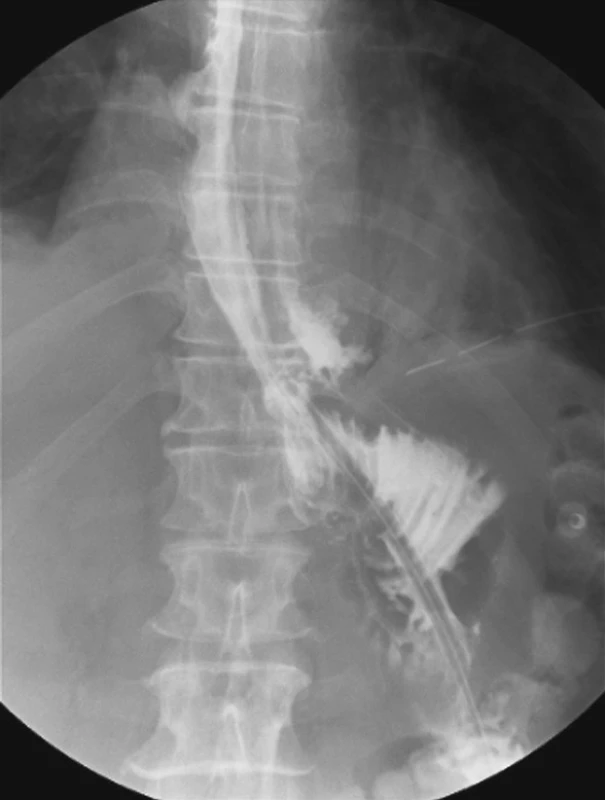 Píštěl v ezofagojejunoanastomóze po totální gastrektomii při kontrolní pasáži sedmý pooperační den
Fig. 1. Fistula in esophagojejunal anastomosis following total gastrectomy, observed on a control passage view on postoperative Day 7