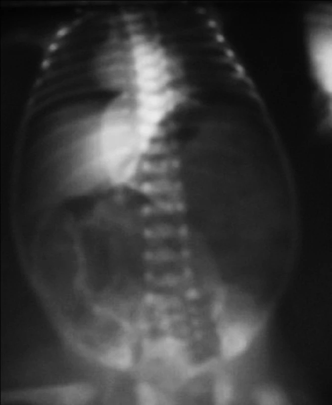 Kontrolná snímka po zavedení centrálneho venózneho katétra s obrazom pneumoperitonea.
Fig. 2. Control image after introduction of venous catheter with the picture of pneumoperitoneum.