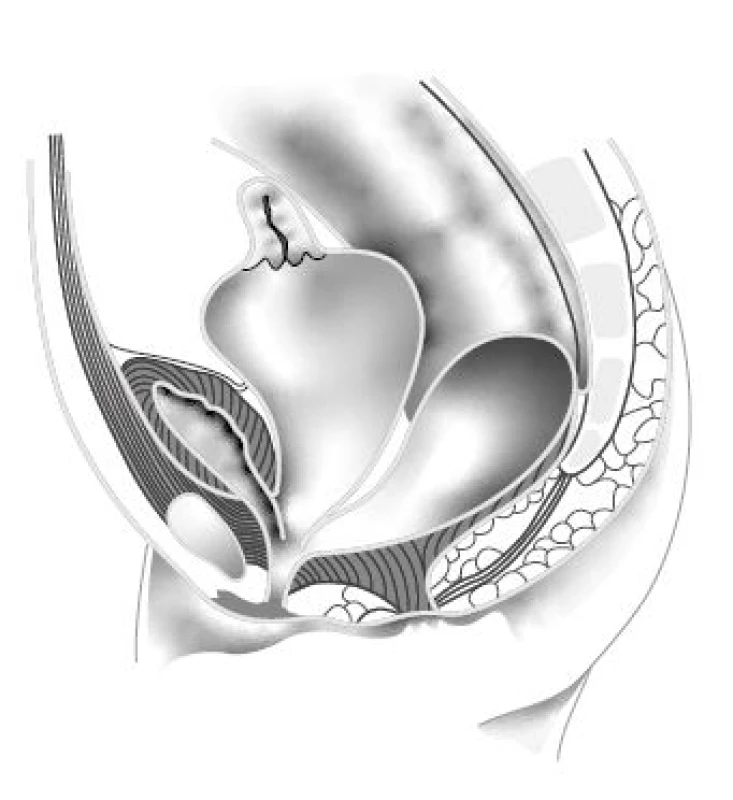 Hydrocolpos a společný kloakální kanál.
(Převzato a upraveno z Levitt MA, Peña A. Cloacal
malformations: lessons learned from 490 cases. Semin
Pediatr Surg. 2010; 19(2): 128–138)<br>
Fig. 2. Hydrocolpos and common channel cloaca.
(Adapted from Levitt MA, Peña A. Cloacal malformations:
lessons learned from 490 cases. Semin Pediatr
Surg. 2010; 19(2): 128–138)