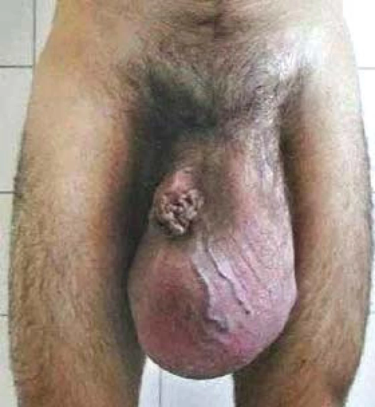 Enormne zväčšený genitál spôsobený nádorom testis.