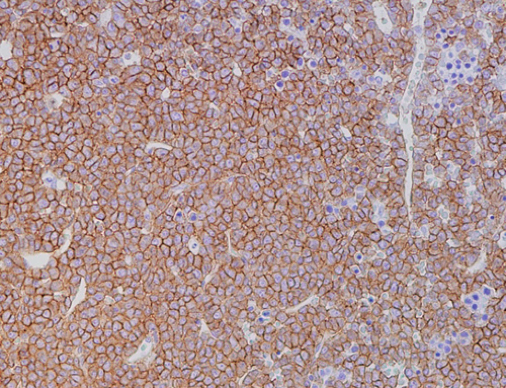 Imunohistochemické vyšetření kostní dřeně, nesekreční myelom, difuzní infiltrace nádorovými plazmocyty s výraznou membránovou pozitivitou CD138 (zvětšení 200x).