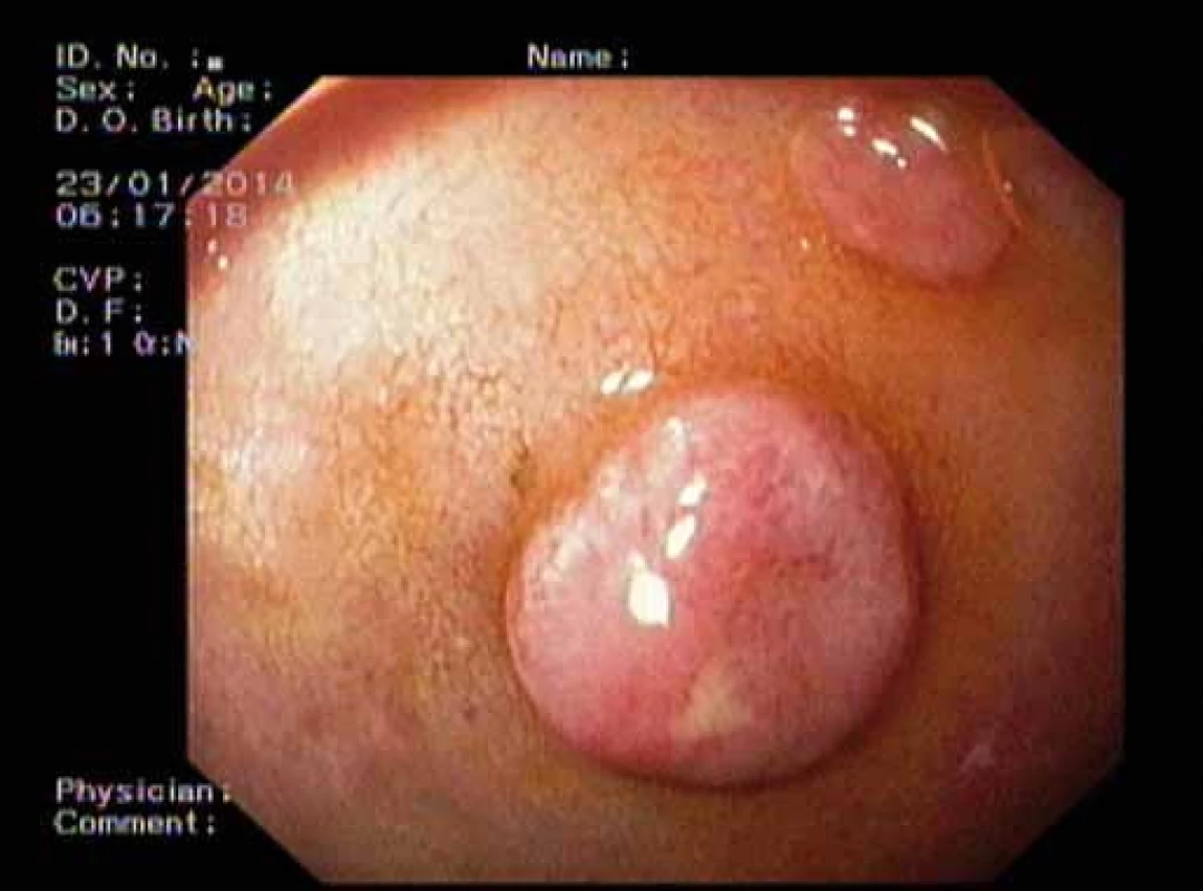 Neuroendokrinní nádory duodena.
Fig. 2. Neuroendocrine tumours of the duodenum.