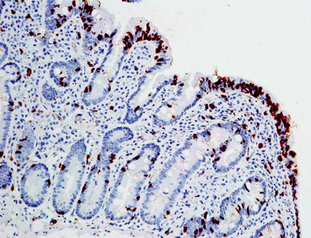 CD8 pozitivní intraepiteliální lymfocyty