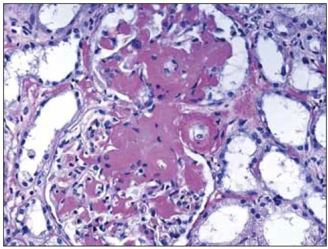 Rozšíření mezangia s amorfními depozity amyloidu, bez proliferace, bez zánětu. Aby mohla být depozita označena za amyloid, musí být kongo červeň pozitivní. Barvení PAS, objektiv 20krát.