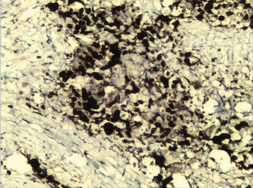 Immunohistochemistry photograph showing positive immunoreactivity for Ki-67 and MIB-1 labelling index of 80%.