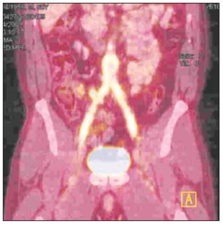FDG-PET/CT obraz infekce aorto-bifemorální cévní protézy v celém jejím průběhu
Fig. 3. A totally infected aorto-bifemoral graft, as detected by FDG-PET/CT
