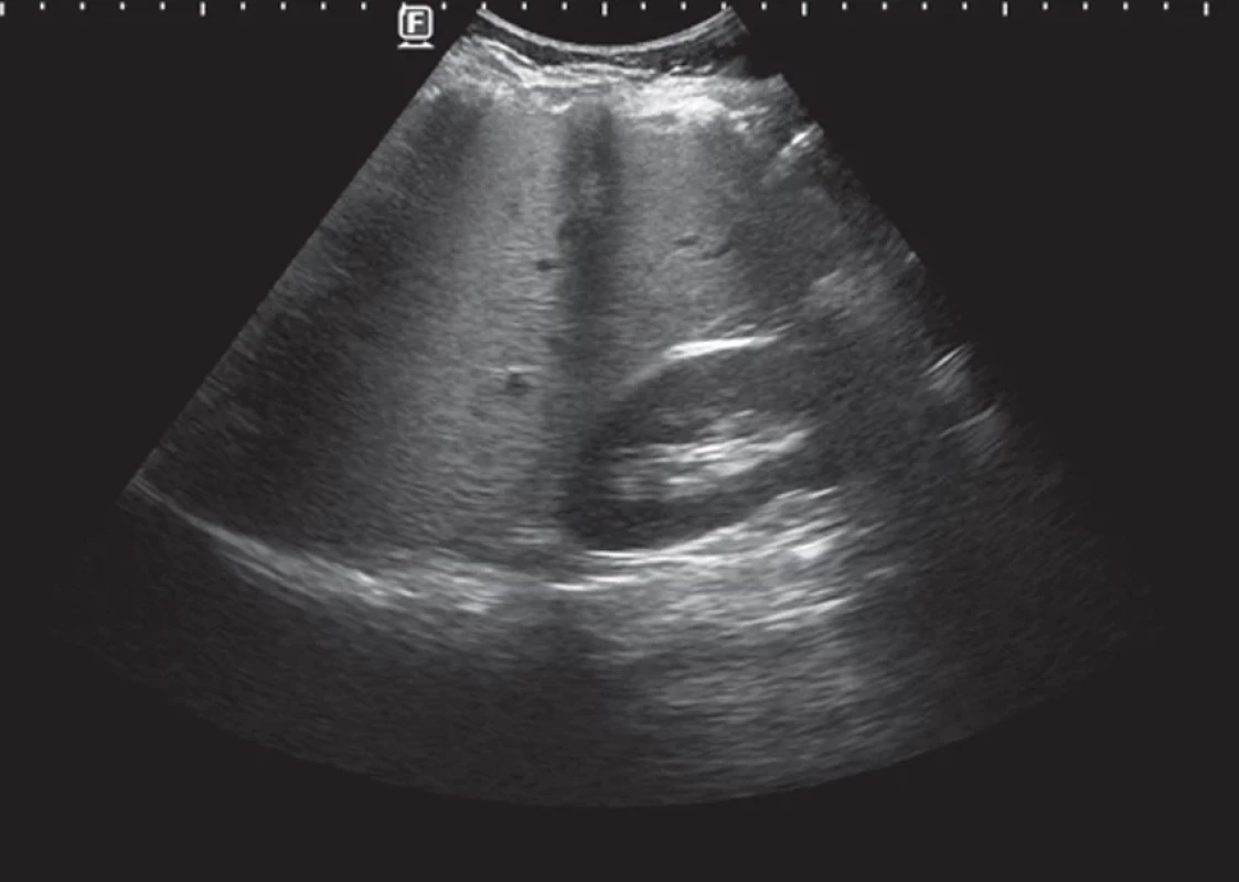 Sonografický nález pri kontrole 9 mesiacov po diagnóze  celiakie so začatím bezlepkovej diéty – mierna hepatomégália  (16,5 cm) s hepatopatiou v zmysle signifikantnej steatózy mierneho  stupňa – hr index 1,6