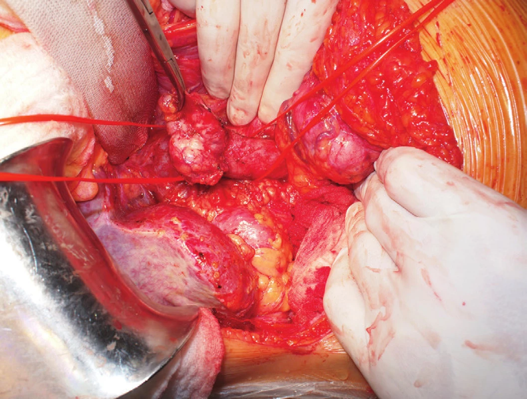 Vypreparovaný tumor a obejitá v. cava inf. nad a pod ním
Fig. 5: Tumor invading inferior caval vein