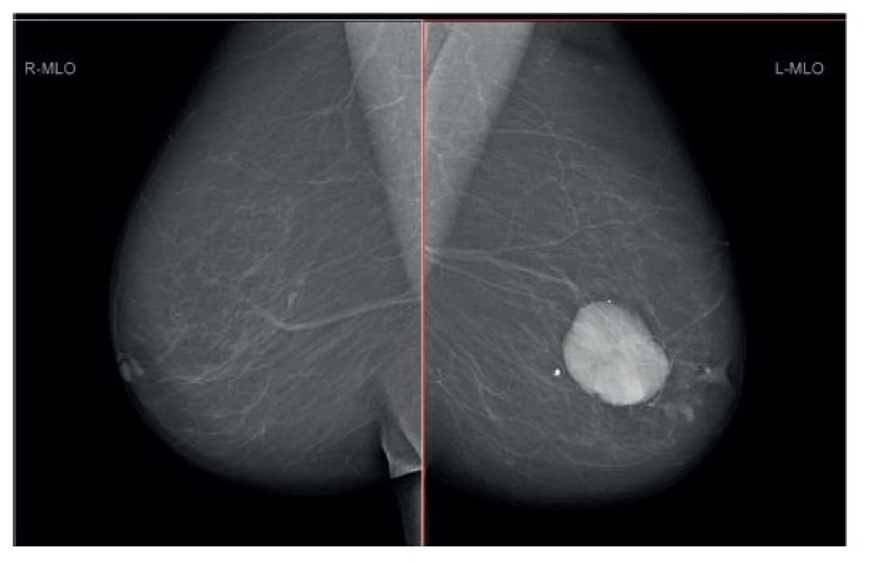 Maligní fyloidní tumor levého prsu – anamnéza 10 let, váha 6500g
Fig. 5: Malignant phyllodes tumour of the left breast – history of ten years, weight of 6500 grams