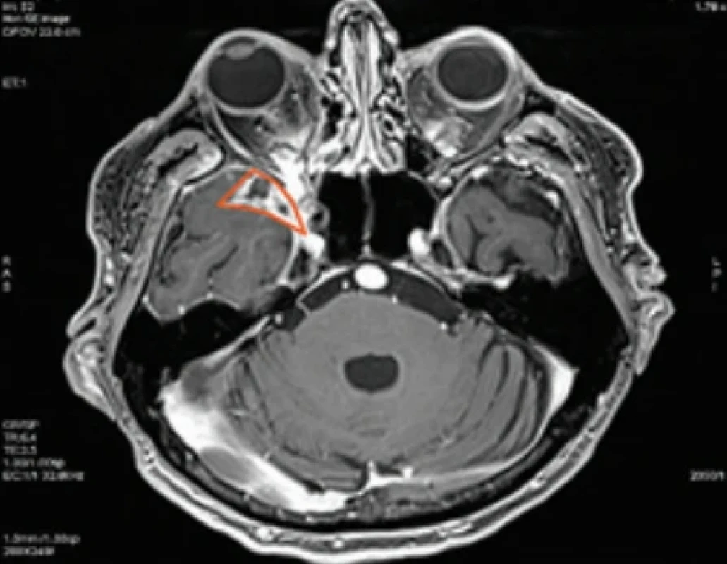 MR obraz mozgu v axiálnom reze s popisovanou léziou v červenom leme. Fig. 1. MR image of the brain in an axial section, showing the lesion outlined in red.